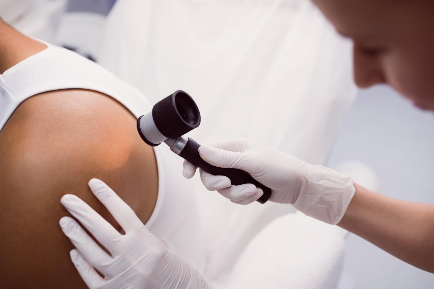 Sinais na pele: 6 tipos para ficar atento e procurar um dermatologista