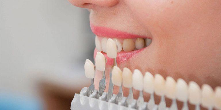 Benefícios da lente de contato dental