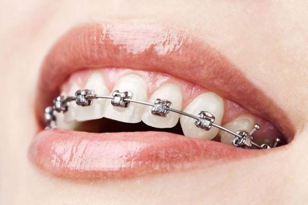 Aparelho dentário: como aliviar a dor após a manutenção