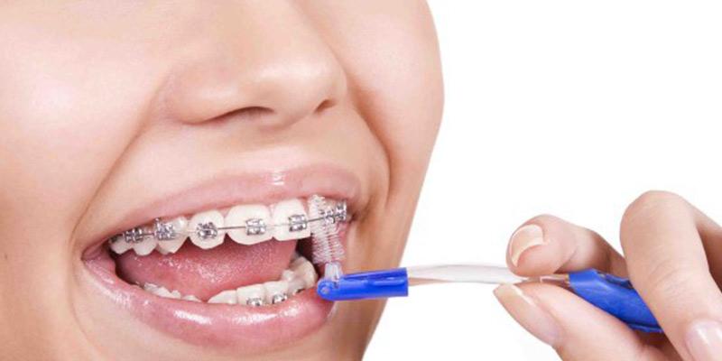 5 dicas de limpeza para quem usa aparelho dentário