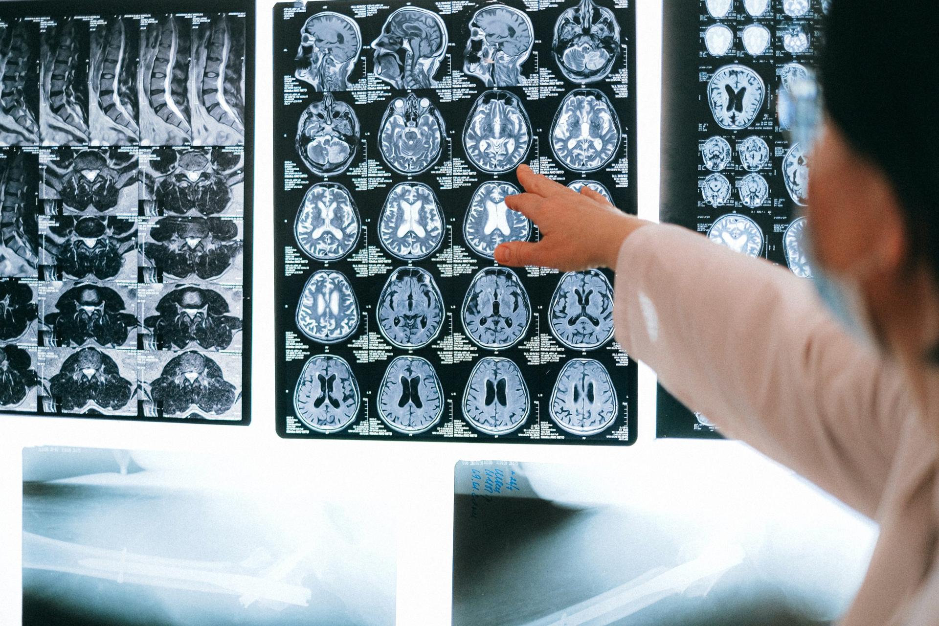 Aneurisma cerebral: quais são os sintomas e tratamentos?