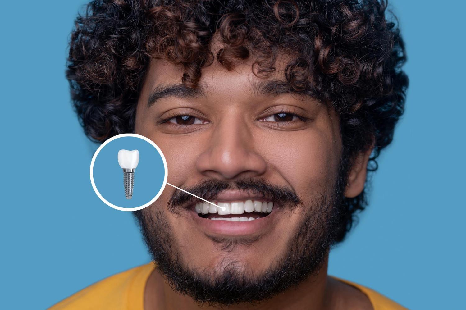 Implante dentário: conheça os benefícios e como é feito