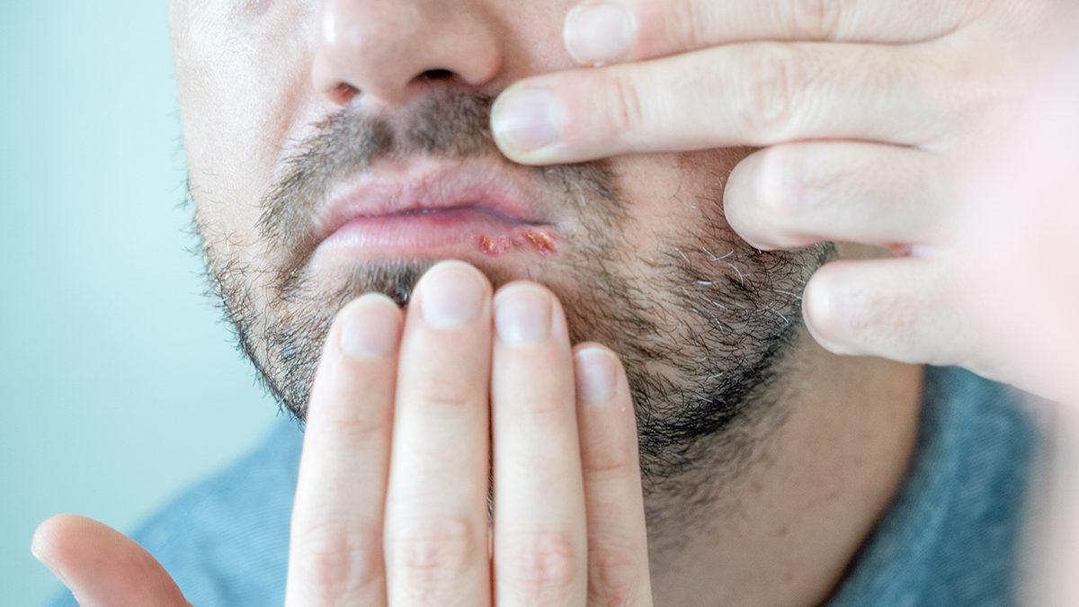 Quantos tipos de herpes existem?