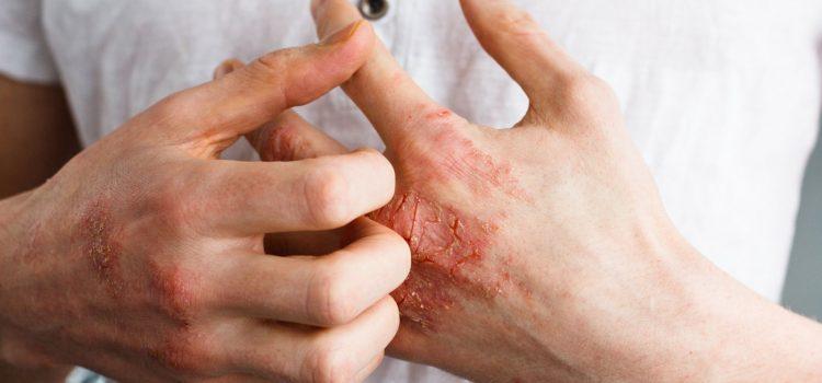 Você conhece a dermatite atópica?