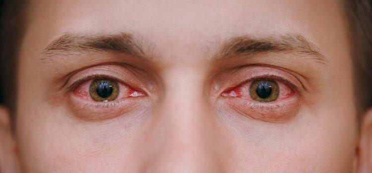 O que causa irritação nos olhos?