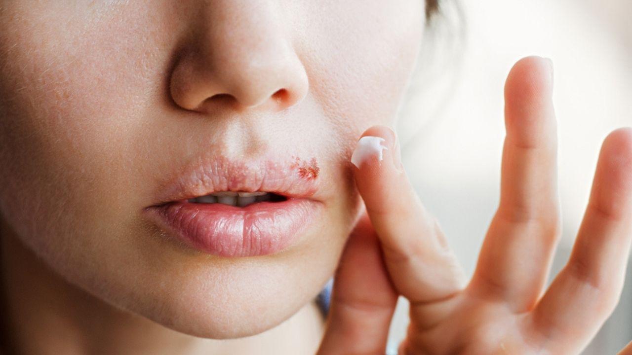 Por que o herpes volta? Descubra como lidar com essa infecção